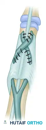 Littler Technique Suture