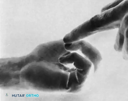 Lumbrical Plus Deformity 1