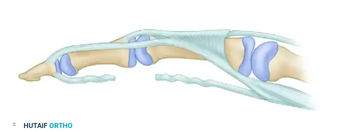 Lumbrical Plus Deformity 2