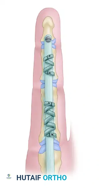 Mastering Flexor Tendon Pulley Reconstruction and Two-Stage Grafting