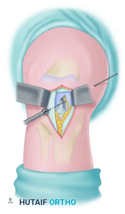 Inside-out method of drilling femoral tunnel