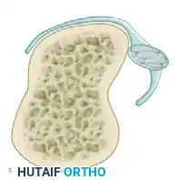 Type III Sagittal Band Injury