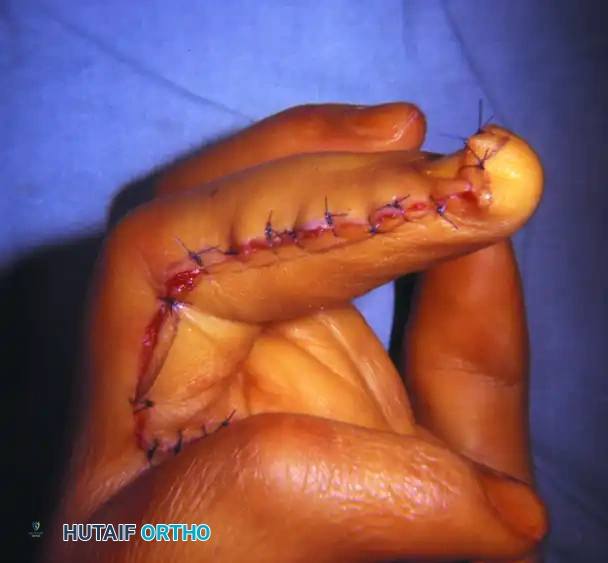 RECONSTRUCTION OF THE HAND AND WRIST Surgical Diagram