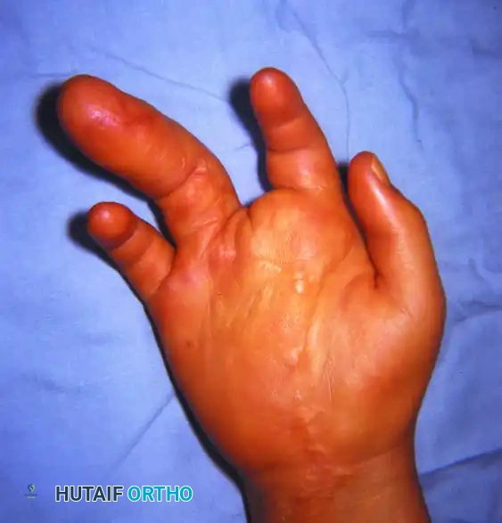 RECONSTRUCTION OF THE HAND AND WRIST Surgical Diagram