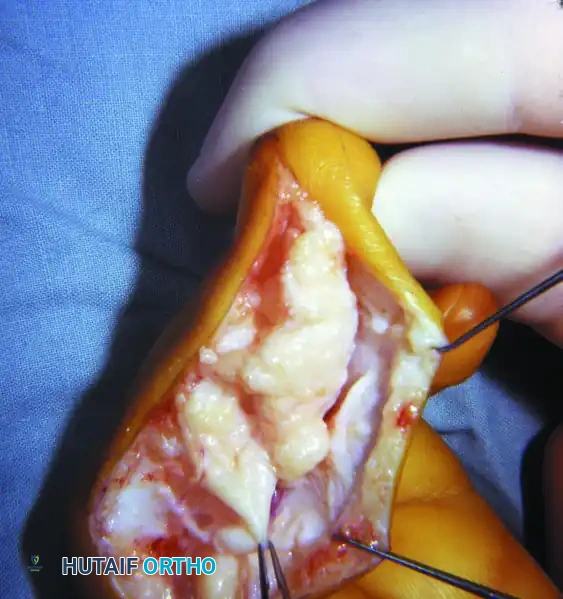 RECONSTRUCTION OF THE HAND AND WRIST Surgical Diagram