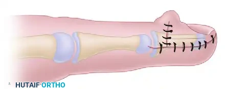 RECONSTRUCTION OF THE HAND AND WRIST Surgical Diagram