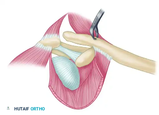 RECONSTRUCTION OF THE SUPERIOR ACROMIOCLAVICULAR LIGAMENT FOR OLD UNREDUCED ACROMIOCLAVICULAR JOINT DISLOCATION Surgical Diagram