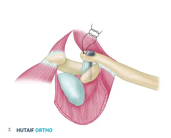 RECONSTRUCTION OF THE SUPERIOR ACROMIOCLAVICULAR LIGAMENT FOR OLD UNREDUCED ACROMIOCLAVICULAR JOINT DISLOCATION Surgical Diagram