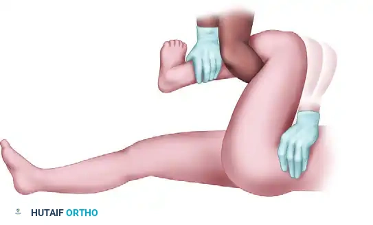 FIGURE 55-59 Stimson maneuver for reduction of hip dislocation.