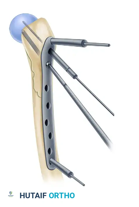 REDUCTION MANEUVERS FOR POSTERIOR HIP DISLOCATION Surgical Diagram