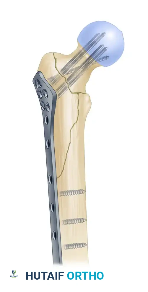 الدليل الشامل لفهم وعلاج خلع الورك الخلفي