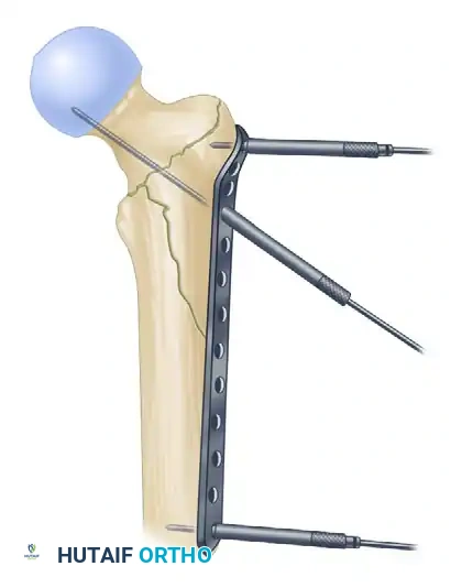 REDUCTION MANEUVERS FOR POSTERIOR HIP DISLOCATION Surgical Diagram