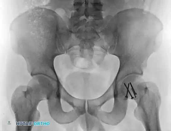 REDUCTION MANEUVERS FOR POSTERIOR HIP DISLOCATION Surgical Diagram