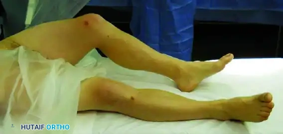 REDUCTION MANEUVERS FOR POSTERIOR HIP DISLOCATION Surgical Diagram