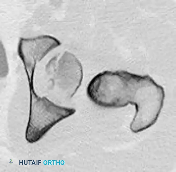 REDUCTION MANEUVERS FOR POSTERIOR HIP DISLOCATION Surgical Diagram