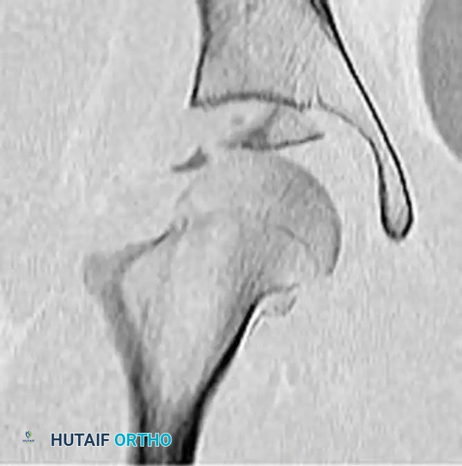 REDUCTION MANEUVERS FOR POSTERIOR HIP DISLOCATION Surgical Diagram