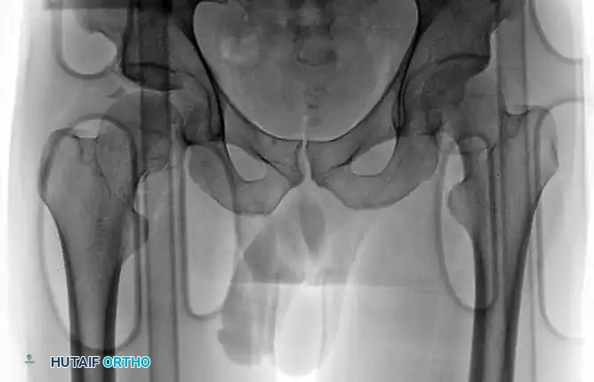 REDUCTION MANEUVERS FOR POSTERIOR HIP DISLOCATION Surgical Diagram