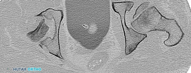 REDUCTION MANEUVERS FOR POSTERIOR HIP DISLOCATION Surgical Diagram