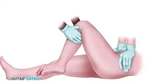 FIGURE 55-57 Allis reduction maneuver for posterior hip dislocation.