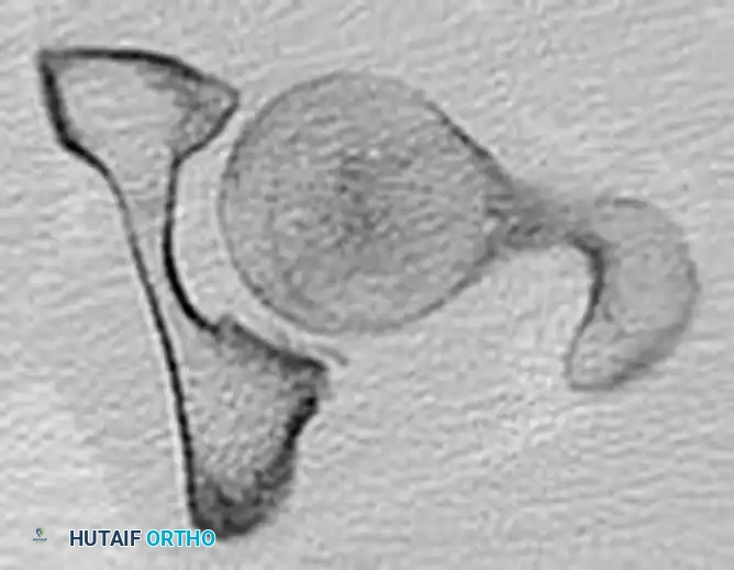 REDUCTION MANEUVERS FOR POSTERIOR HIP DISLOCATION Surgical Diagram