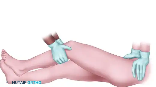 FIGURE 55-57 Allis reduction maneuver for posterior hip dislocation.
