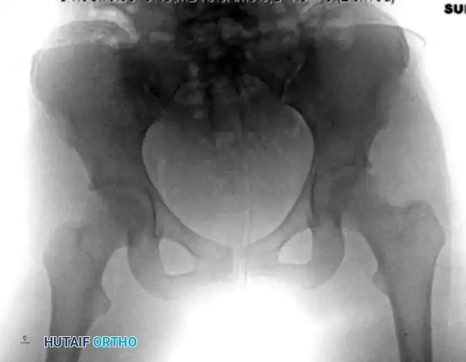 REDUCTION MANEUVERS FOR POSTERIOR HIP DISLOCATION Surgical Diagram
