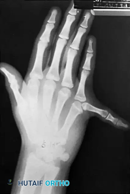 REDUCTION OSTEOTOMY Surgical Diagram