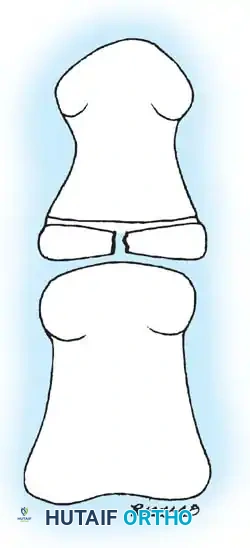 Comprehensive Management of Pediatric Physeal and Forearm Fractures