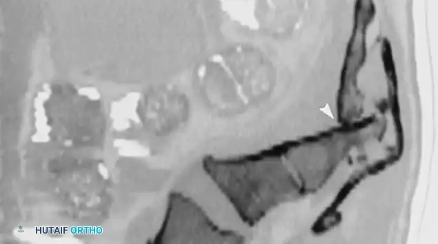 Fig. 35-62 A, Sagittal CT scan of transverse fracture through S3 resulting in transection of sacral nerve roots (arrow) . B, MRI of sacral fracture resulting in complete canal compromise. C, Postoperative CT scan shows decompression of sacral spinal canal after laminectomy (arrows) .