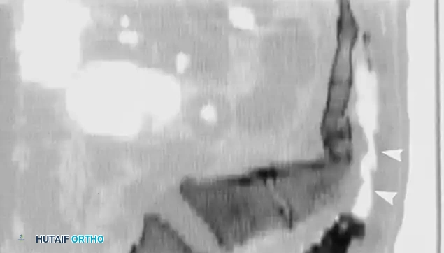 Fig. 35-62 A, Sagittal CT scan of transverse fracture through S3 resulting in transection of sacral nerve roots (arrow) . B, MRI of sacral fracture resulting in complete canal compromise. C, Postoperative CT scan shows decompression of sacral spinal canal after laminectomy (arrows) .