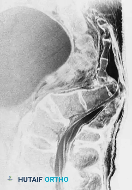 Fig. 35-62 A, Sagittal CT scan of transverse fracture through S3 resulting in transection of sacral nerve roots (arrow) . B, MRI of sacral fracture resulting in complete canal compromise. C, Postoperative CT scan shows decompression of sacral spinal canal after laminectomy (arrows) .