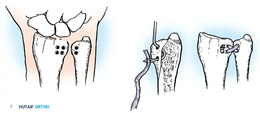 Mastering Acute Joint Dislocations and Ligamentous Reconstruction