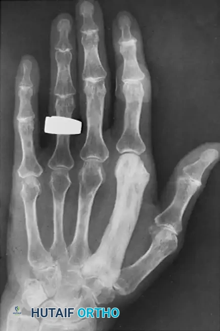 Fig. 74-39 Paget disease of second metacarpal. (From Haverbush TJ, Wilde AH, Phalen GS: The hand in Paget’s disease of bone: report of two cases, J Bone Joint Surg 54A:173, 1972.)