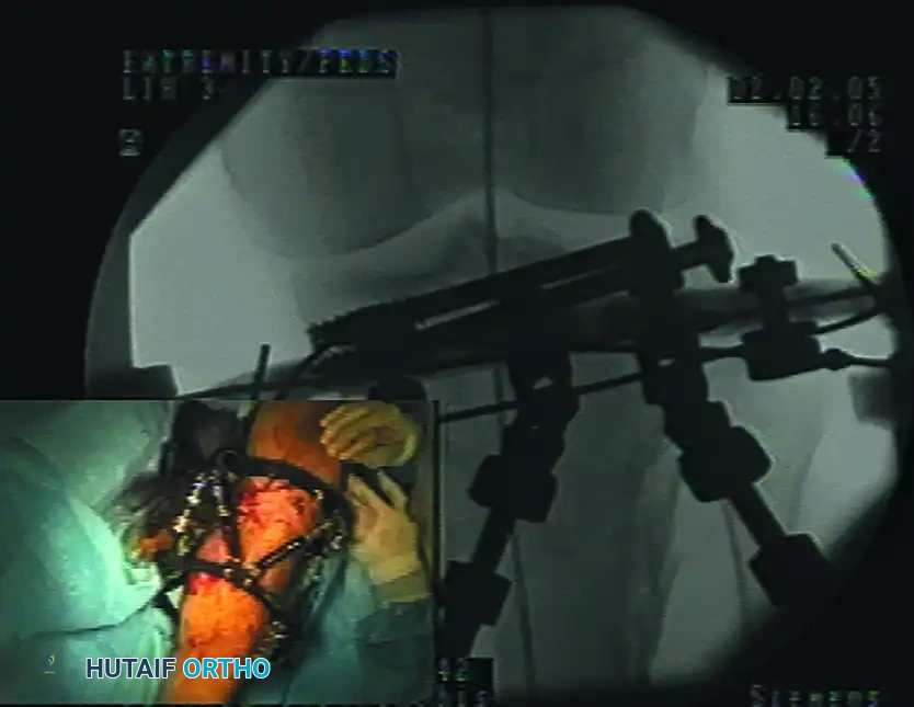 استخدام المسامير لتثبيت سطح المفصل مع جهاز التثبيت الخارجي لحماية الأنسجة الرخوة