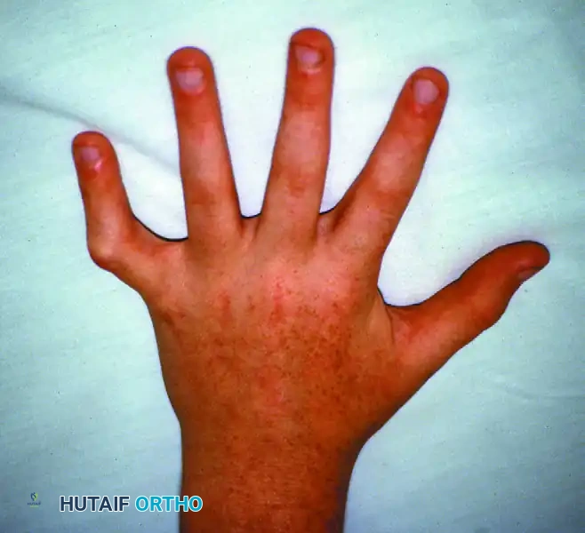 Congenital Trigger Thumb Surgical Diagram