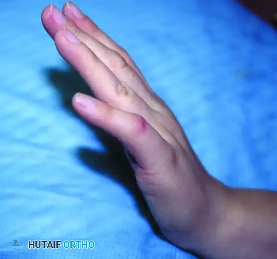 Camptodactyly Wrist Flexion