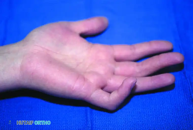 Camptodactyly Clinical Presentation