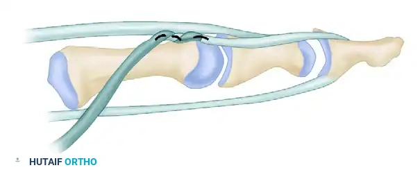 FDS Transfer Technique Start