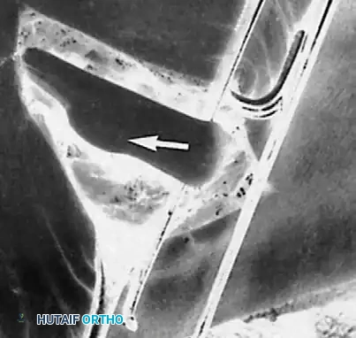 Flexor hallucis longus constricted at entrance of fibroosseous tunnel