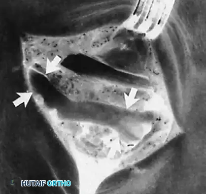 Large nodule within fibroosseous tunnel