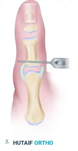 Operative Repair and Reconstruction of the Thumb Ulnar Collateral Ligament
