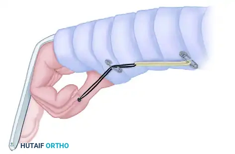 REPAIR IN ZONES III, IV, AND V Surgical Diagram