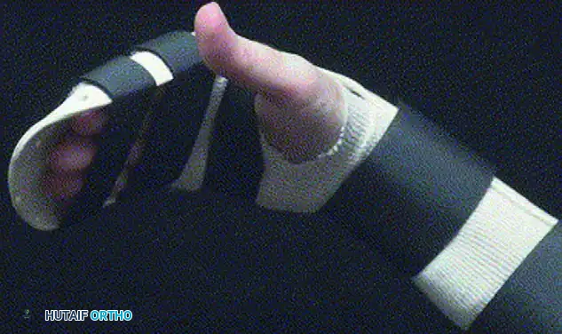 REPAIR IN ZONES III, IV, AND V Surgical Diagram