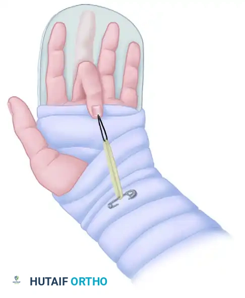 Flexor Tendon Repair in Zones III, IV, and V: Surgical Guide