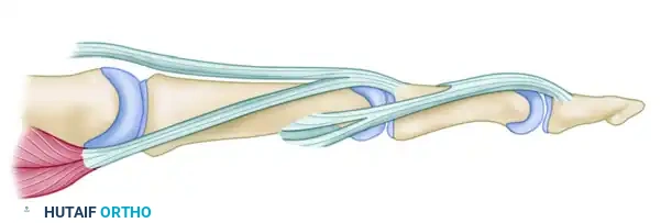 REPAIR OF CENTRAL SLIP OF THE EXTENSOR EXPANSION CAUSING BUTTONHOLE DEFORMITY Surgical Diagram