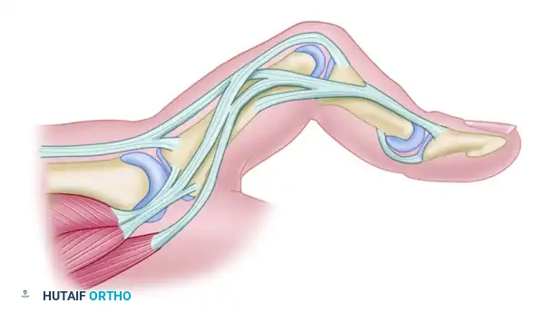 REPAIR OF CENTRAL SLIP OF THE EXTENSOR EXPANSION CAUSING BUTTONHOLE DEFORMITY Surgical Diagram