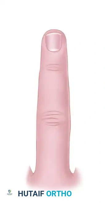 REPAIR OF CENTRAL SLIP OF THE EXTENSOR EXPANSION CAUSING BUTTONHOLE DEFORMITY Surgical Diagram