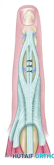 REPAIR OF CENTRAL SLIP OF THE EXTENSOR EXPANSION CAUSING BUTTONHOLE DEFORMITY Surgical Diagram