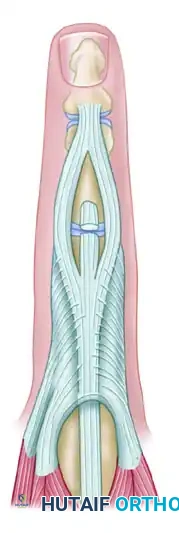 REPAIR OF CENTRAL SLIP OF THE EXTENSOR EXPANSION CAUSING BUTTONHOLE DEFORMITY Surgical Diagram