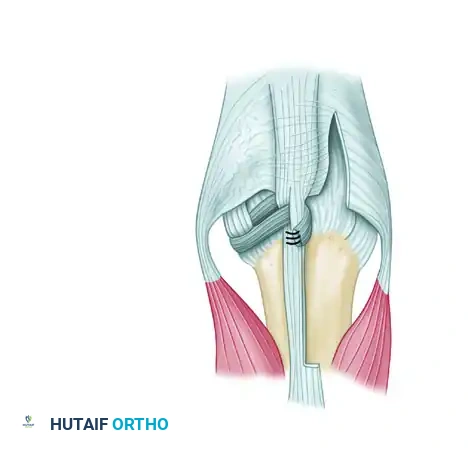 REPAIR OF TRAUMATIC DISLOCATION OF THE EXTENSOR TENDON Surgical Diagram